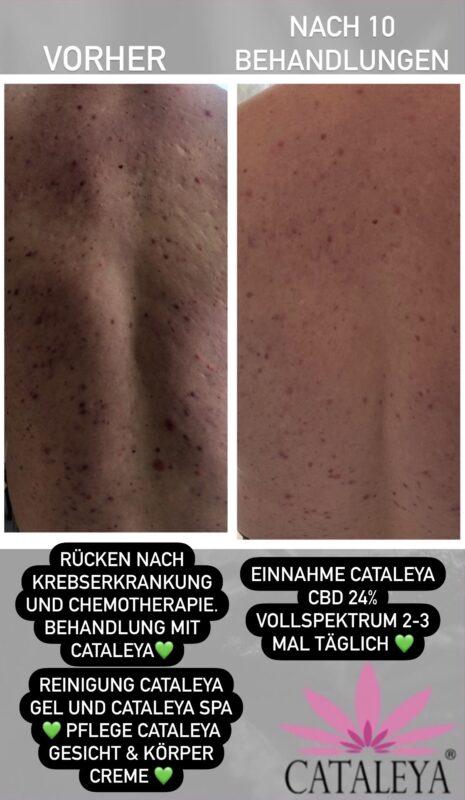 Bewertung, Bewertungen, Erfahrung, Erfahrungen, Feedback, Wirkung, CBD, Hanf, Cannabidiol, Öl, Hanfcreme, Hanfkosmetik, Unreine Haut, CBD Öl Einnahme, Einnahme, Schlafprobleme, Schmerzen, Kopfschmerzen, Migräne, Krebserkrannkungen, Krebscbd, Krebsdiagnose, Tumor, Zellen, Akne, Mitesser, Pickel, Narben, Darmgesundheit, Collagen, Kollagen,