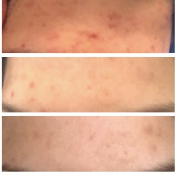 Bewertung, Bewertungen, Erfahrung, Erfahrungen, Feedback, Wirkung, CBD, Hanf, Cannabidiol, Öl, Hanfcreme, Hanfkosmetik, Unreine Haut, CBD Öl Einnahme, Einnahme, Schlafprobleme, Schmerzen, Kopfschmerzen, Migräne, Krebserkrannkungen, Krebscbd, Krebsdiagnose, Tumor, Zellen, Akne, Mitesser, Pickel, Narben, Darmgesundheit, Collagen, Kollagen,
