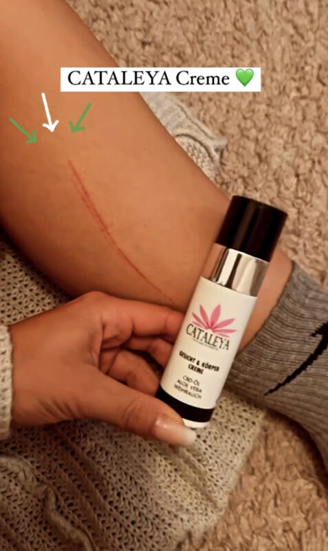 Bewertung, Bewertungen, Erfahrung, Erfahrungen, Feedback, Wirkung, CBD, Hanf, Cannabidiol, Öl, Hanfcreme, Hanfkosmetik, Unreine Haut, CBD Öl Einnahme, Einnahme, Schlafprobleme, Schmerzen, Kopfschmerzen, Migräne, Krebserkrannkungen, Krebscbd, Krebsdiagnose, Tumor, Zellen, Akne, Mitesser, Pickel, Narben, Darmgesundheit, Collagen, Kollagen,